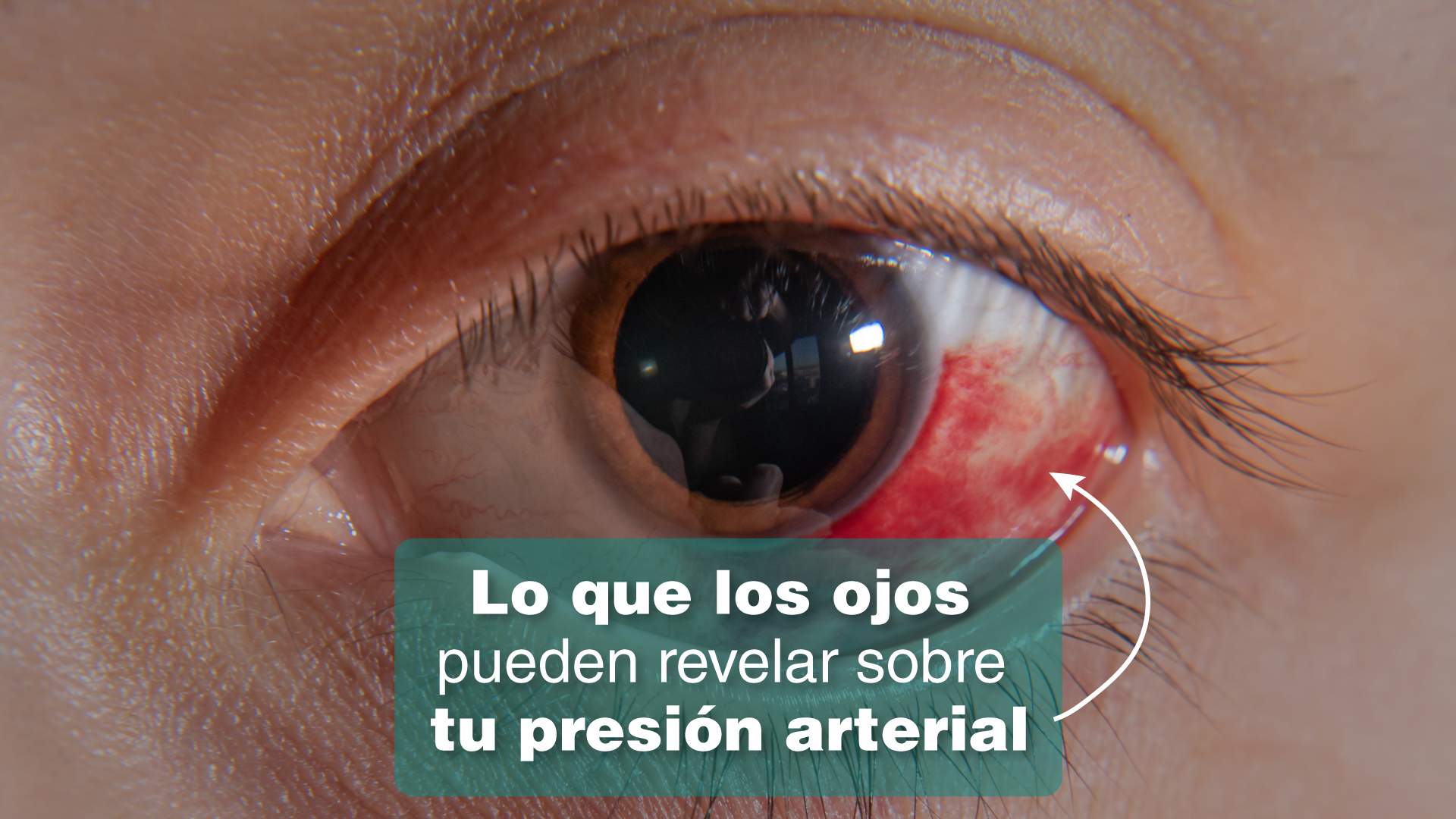 Presión arterial y ojos ¿por qué aparecen manchas rojas sin motivo - Julieta Vera
